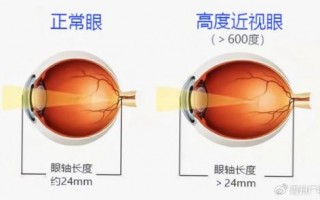 4.2视力是多少度，4.2视力是多少度近视