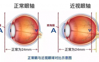 散光是42轴位是多少度，散光轴位43